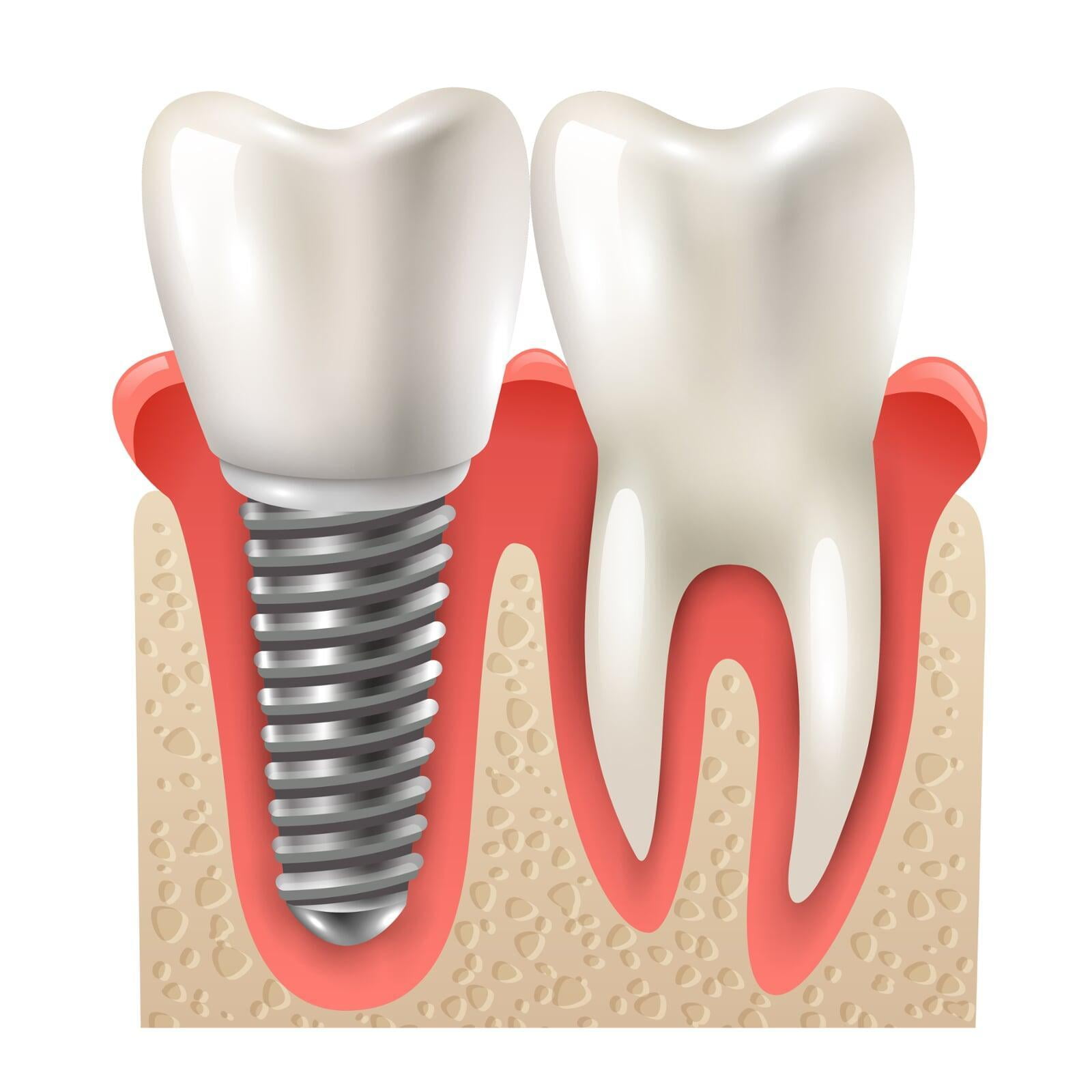 FAQs from 4 to 6 months of Dental Implant Surgery