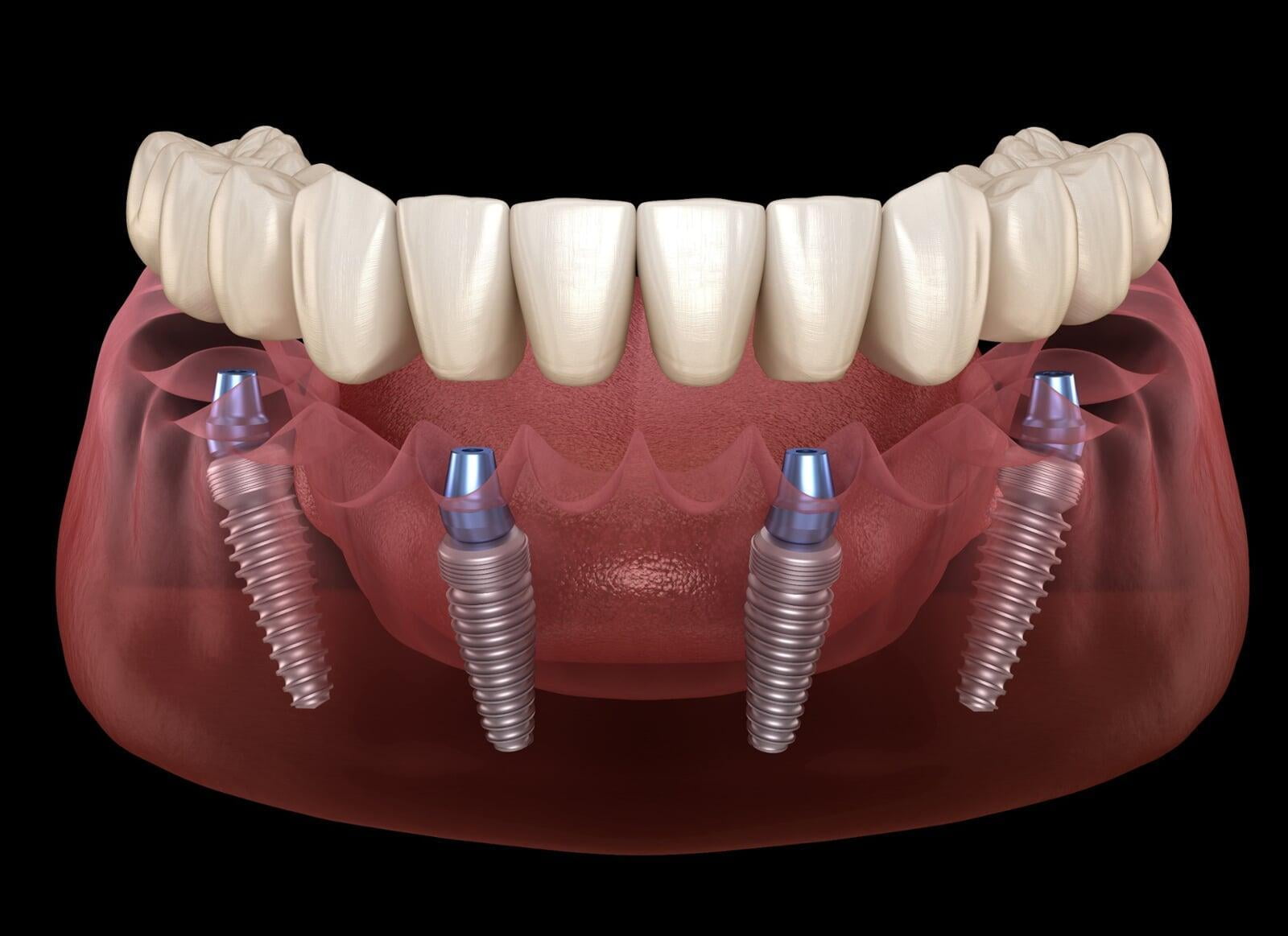 All-on-4 Dental Treatment Concept - The Latest Advancements in Dental Restoration