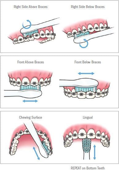 Brushing Technique for Patients with Braces