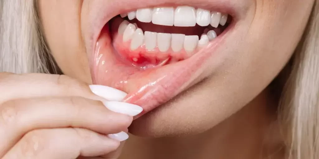 Why Gums Bleed When Flossing — When to Worry