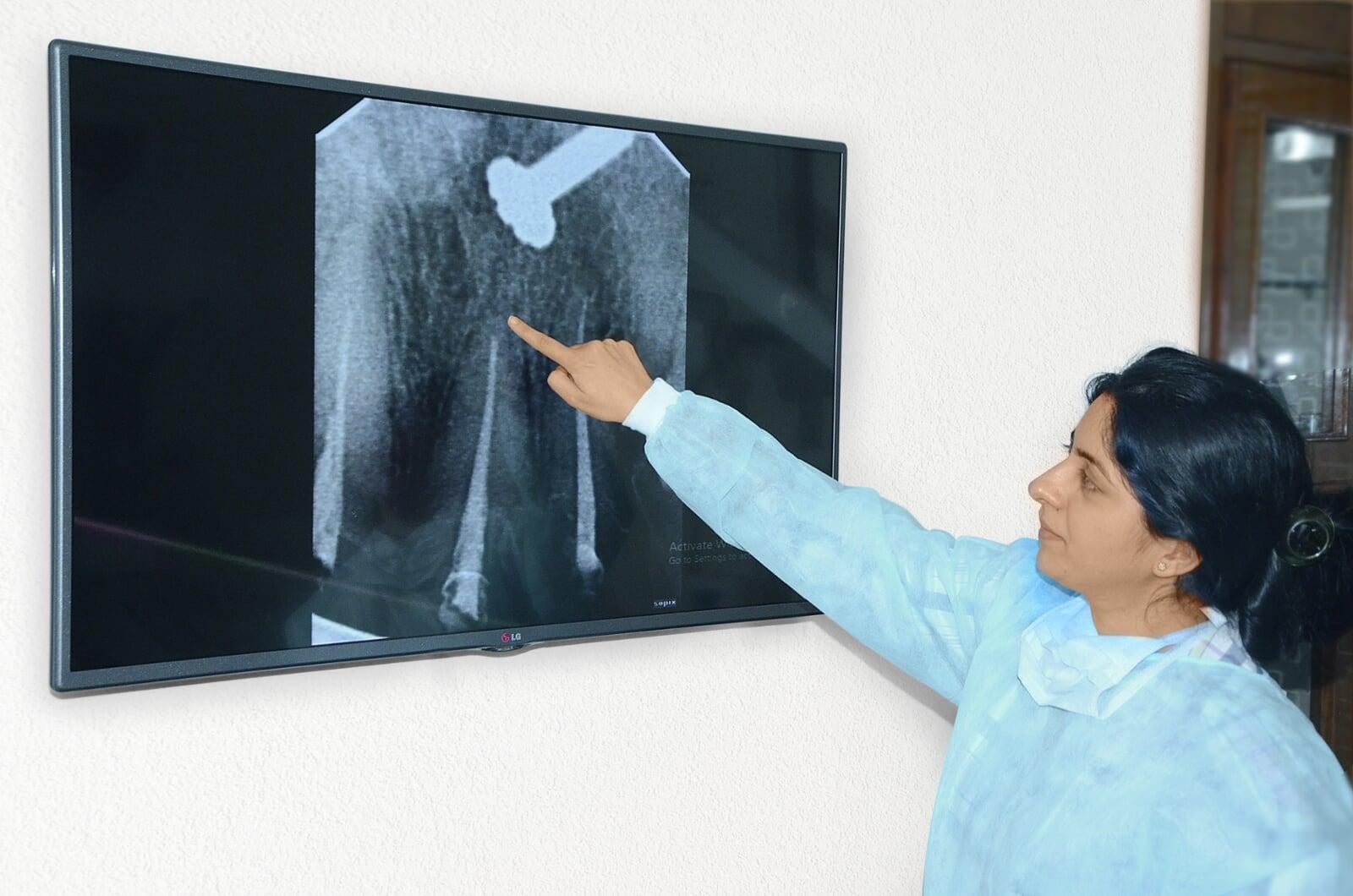 Laser Disinfected Root Canal Therapy