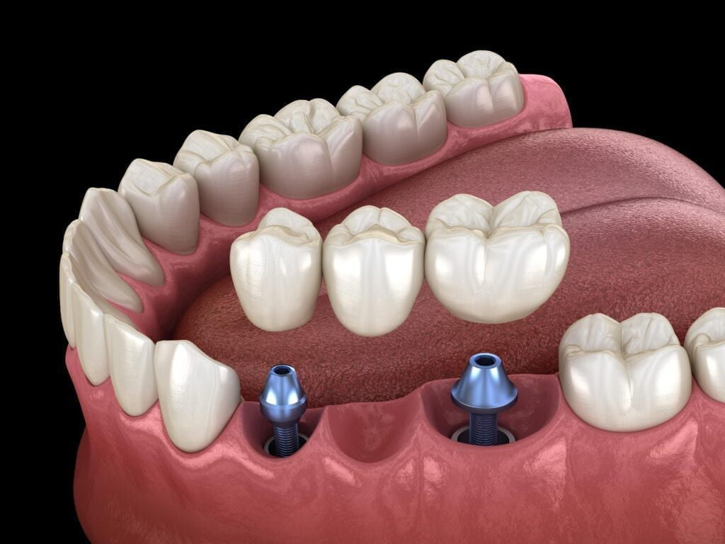 Dental Implant Bridges