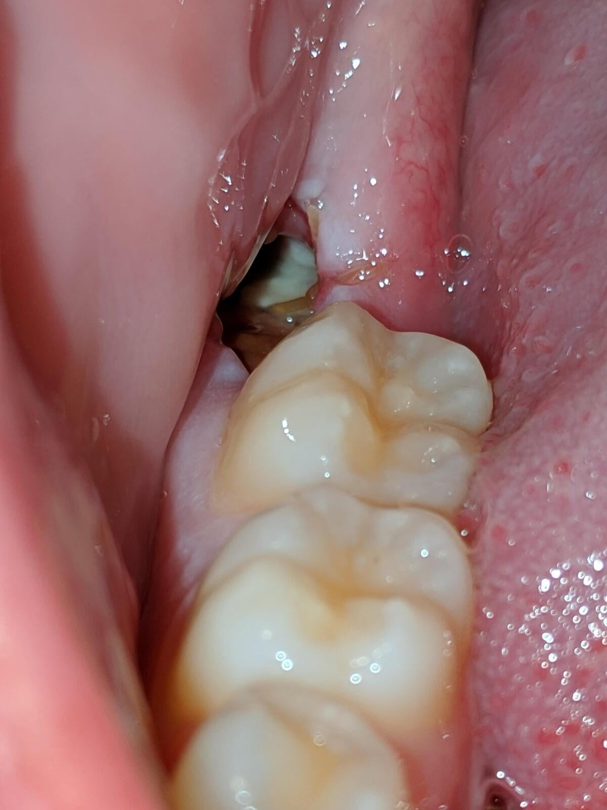 Dry Socket after tooth extraction