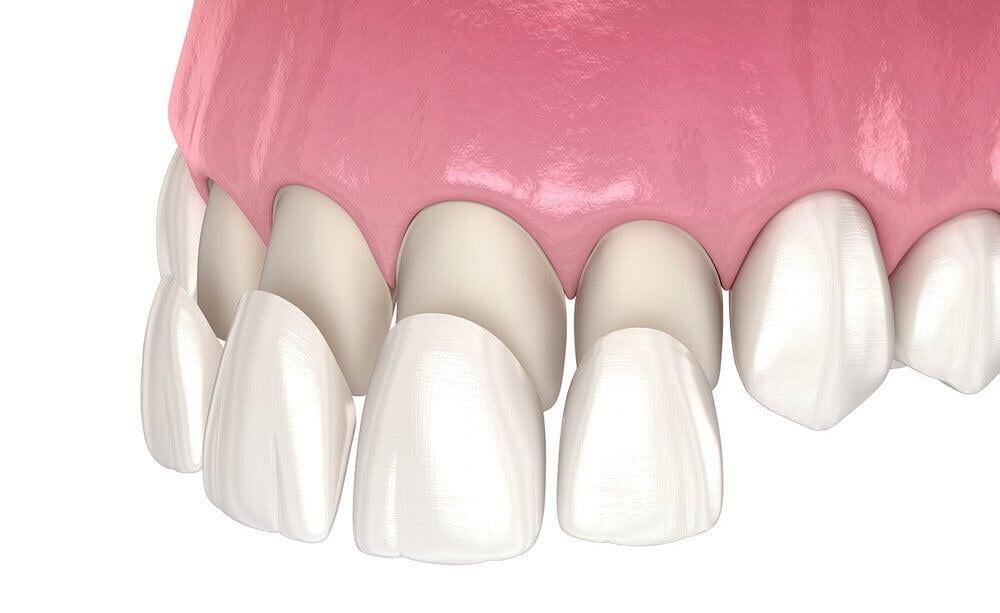 Veneers