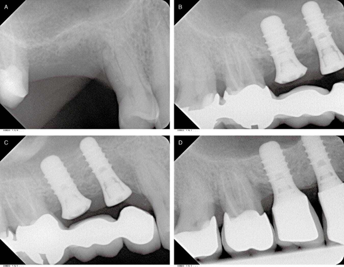 Treatment for dental bone loss