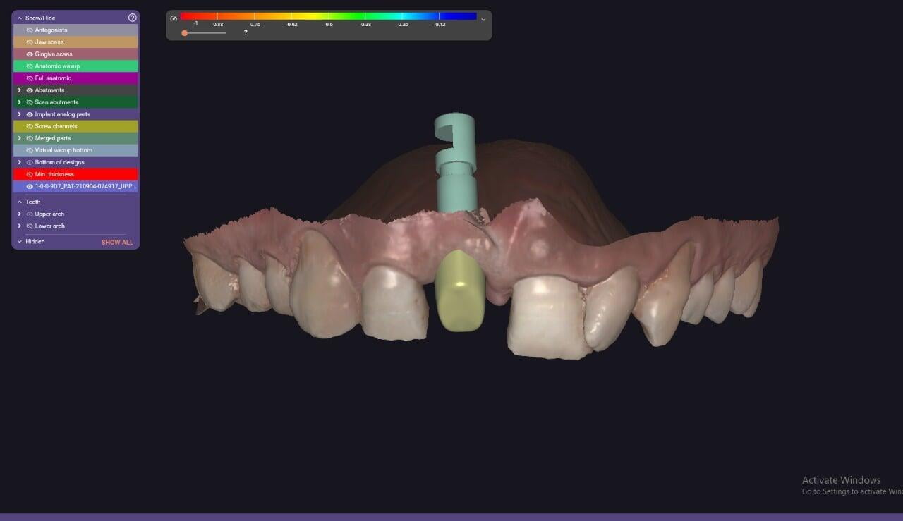 A Single Dental Implant Restoration