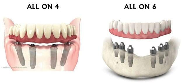 What is Right for You: All-on-6 or All-on-4 Dental Implants