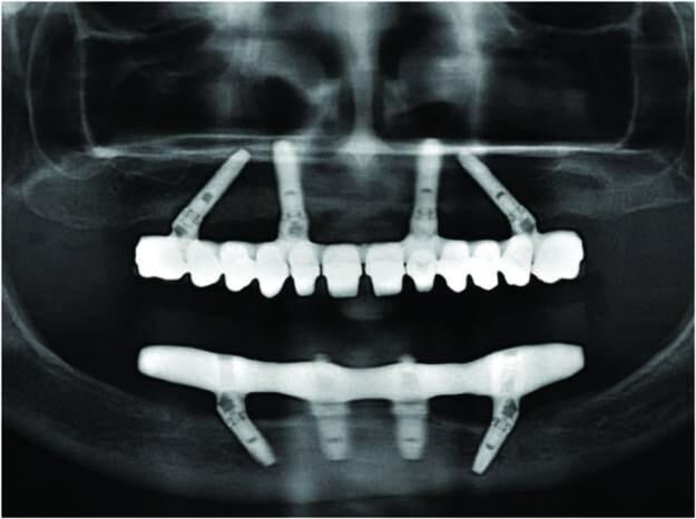 Number of dental implants affect the cost