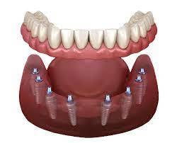 All-on-8 Dental Implants