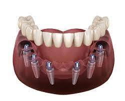 All-on-6 Dental Implants