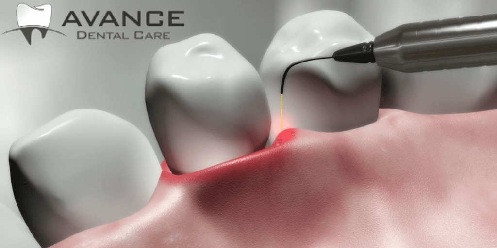 Pros and Cons of Laser Root Canal Therapy