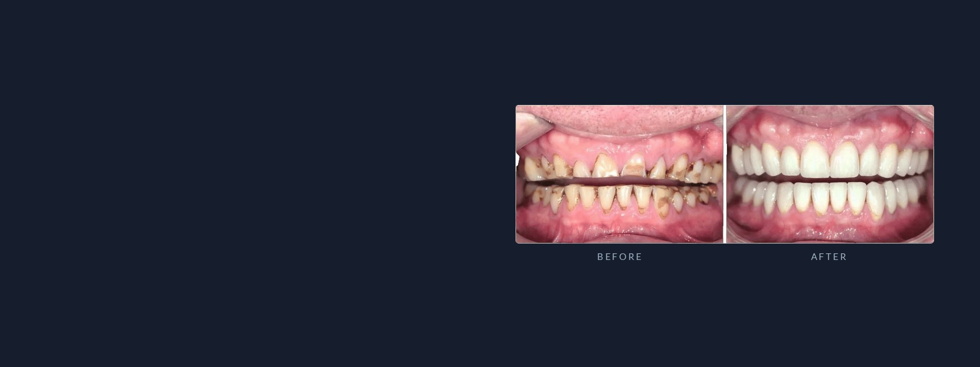 Before and after smile restoration at ADC – Centre for Restorative and Implant Dentistry, Chandigarh: worn, damaged teeth restored to a natural, confident smile