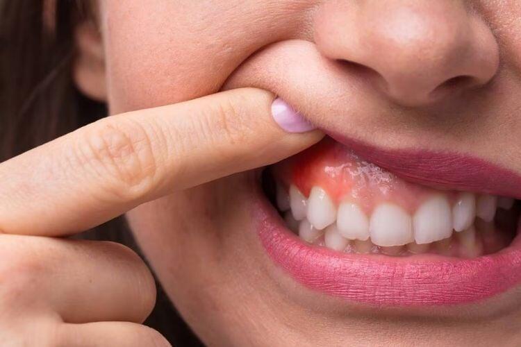 Living with Dentures