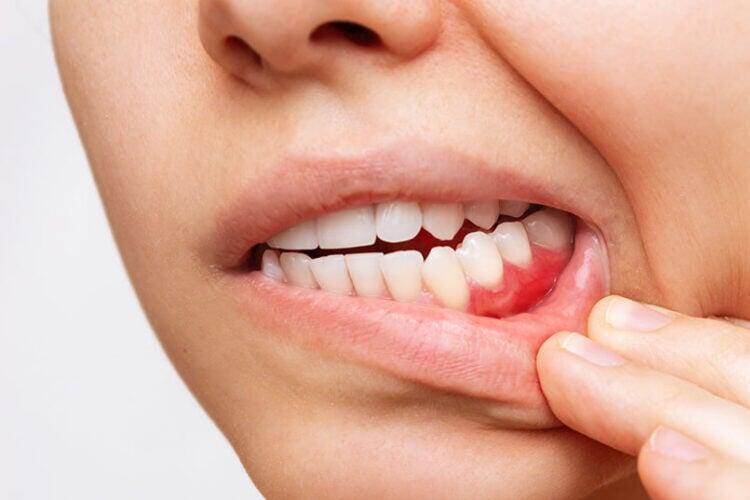 Living with Dentures