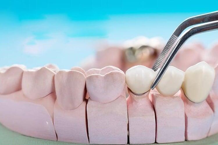 Dental Implants