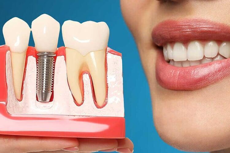 Dental Implants