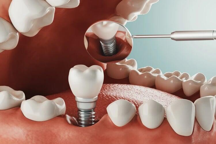 A Complete Guide to Root Canal Treatment: What to Expect & Benefits