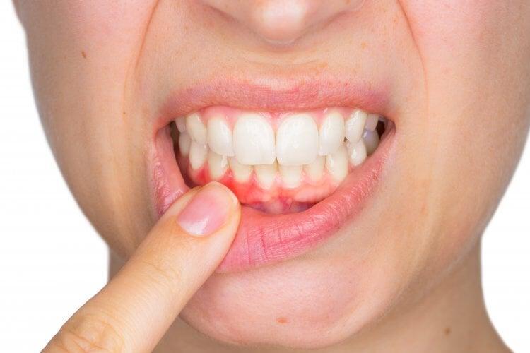 A Complete Guide to Root Canal Treatment: What to Expect & Benefits