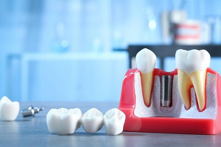 How to Care for Your Dental Crowns & Bridges Dentist Tips