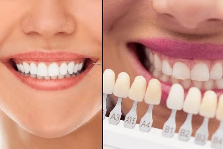 Veneers vs Whitening – Which Is Best for Your Smile?