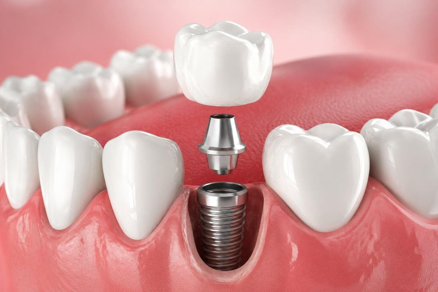 Complete Guide to Dental Implants in Chandigarh