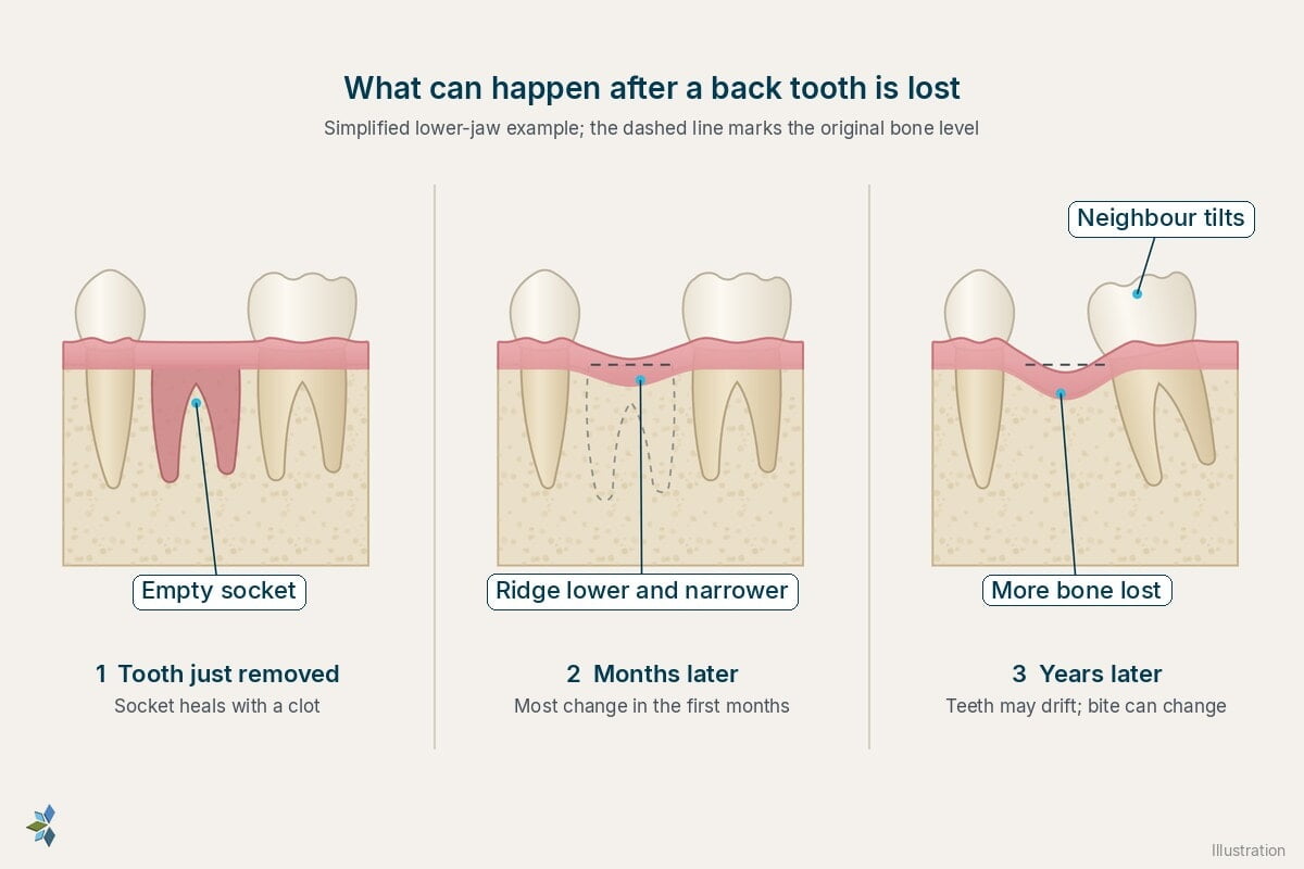 Three stages after a lower back tooth is lost: just after removal the empty socket heals with a clot; months later the ridge is lower and narrower; years later more bone is lost and the neighbouring tooth has tilted into the gap