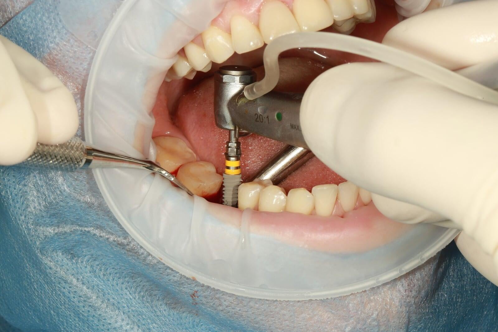 Frequently Asked Questions after Dental Implant Surgery