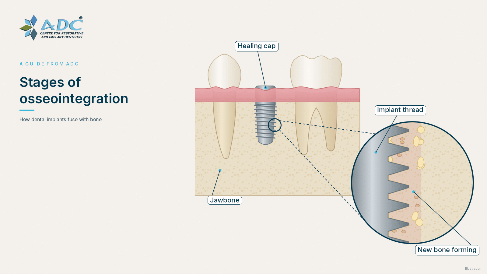 Diagram of a dental implant healing in the jawbone under the gum with a healing cap, and a magnified circle showing new bone growing into close contact with the implant threads