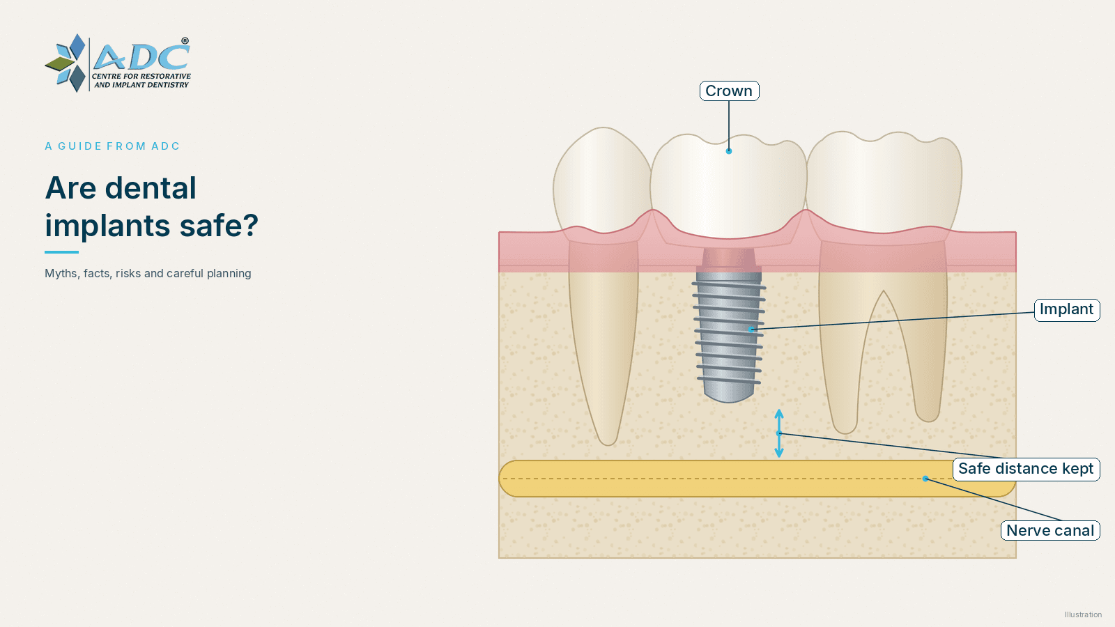 Are dental implants safe? Myths, facts and risks