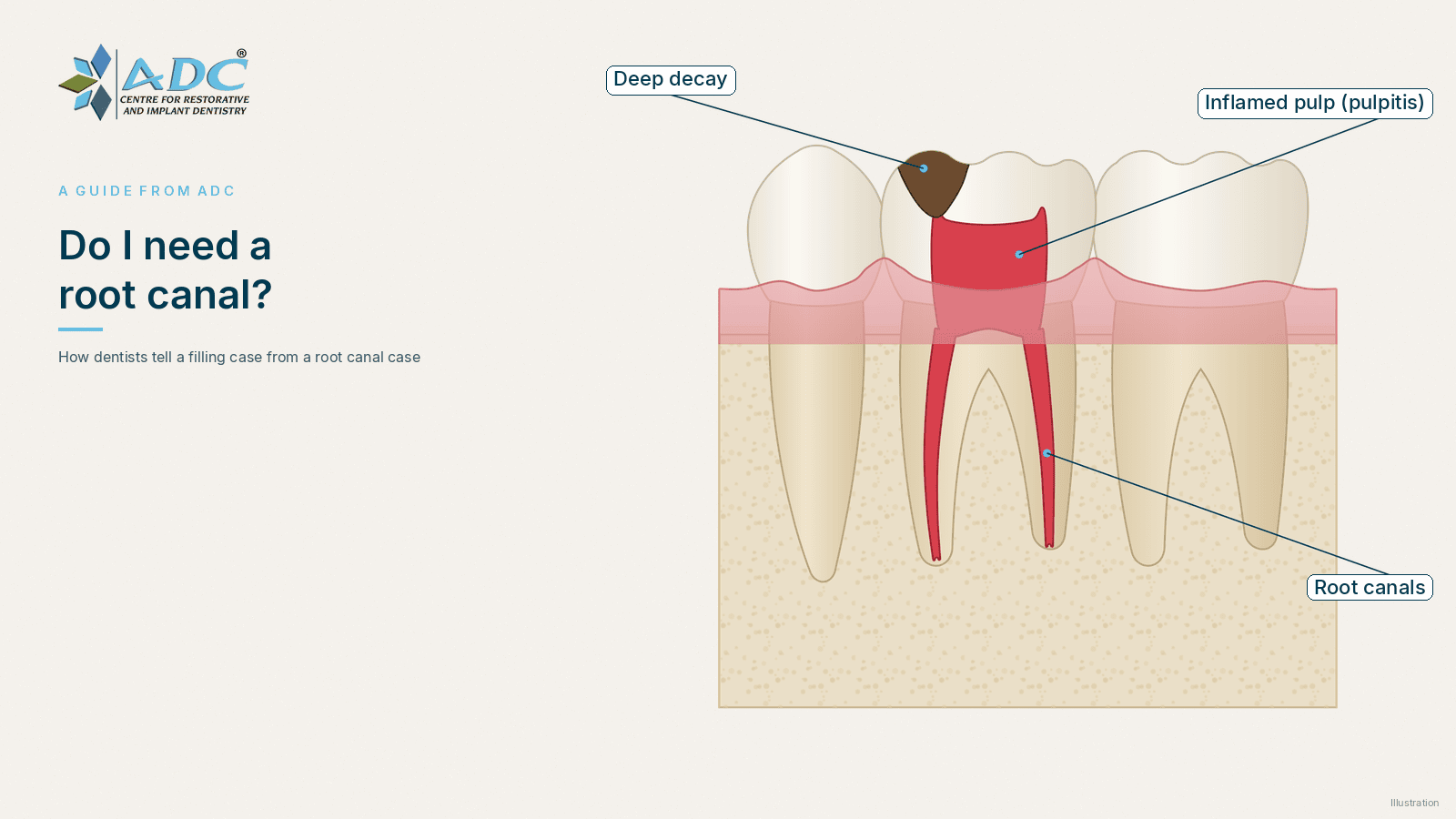 Do I need a root canal? How dentists decide