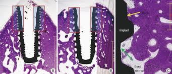 Stages of Dental Implant Osseointegration