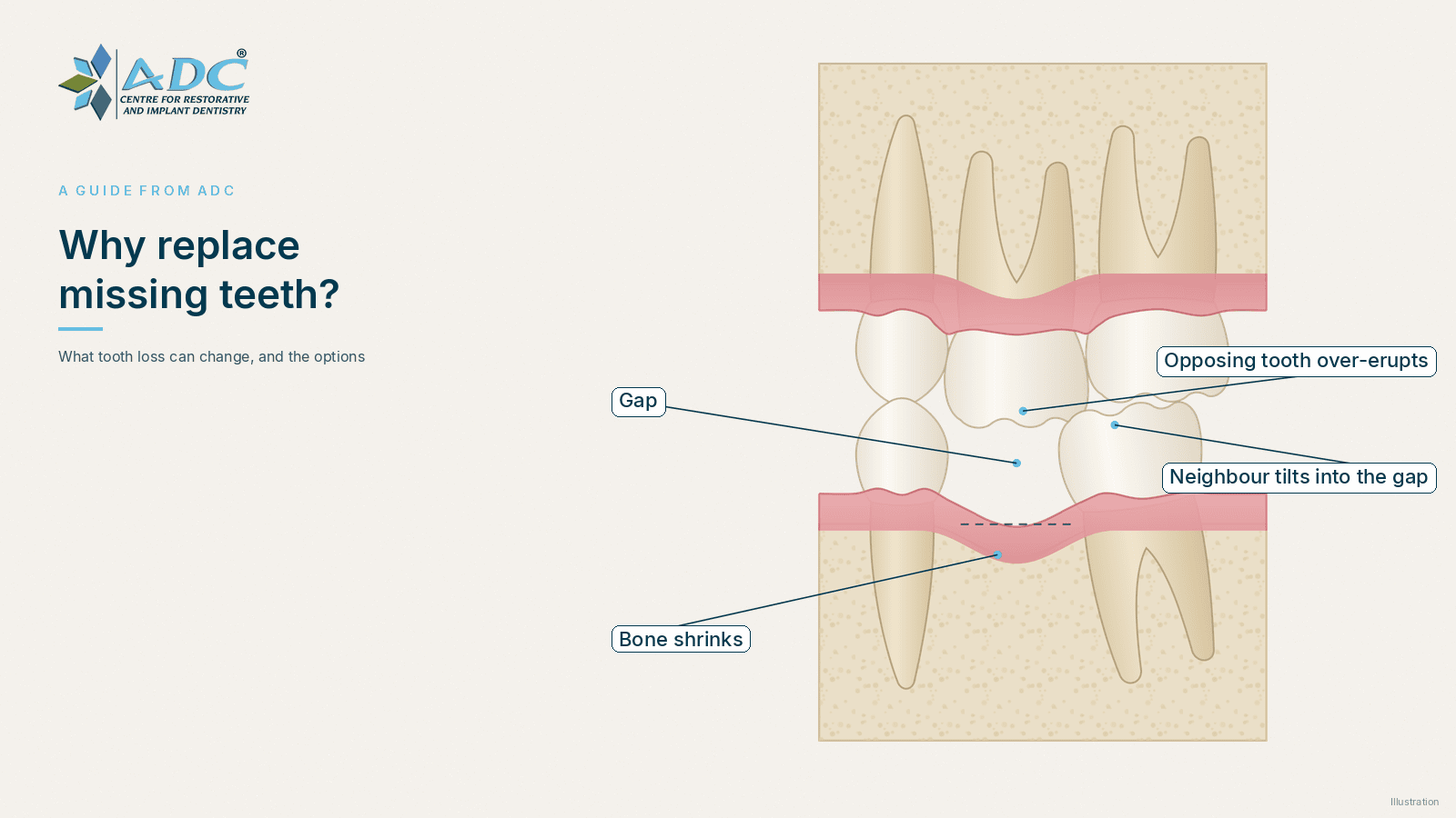 Why replace missing teeth? Effects and options