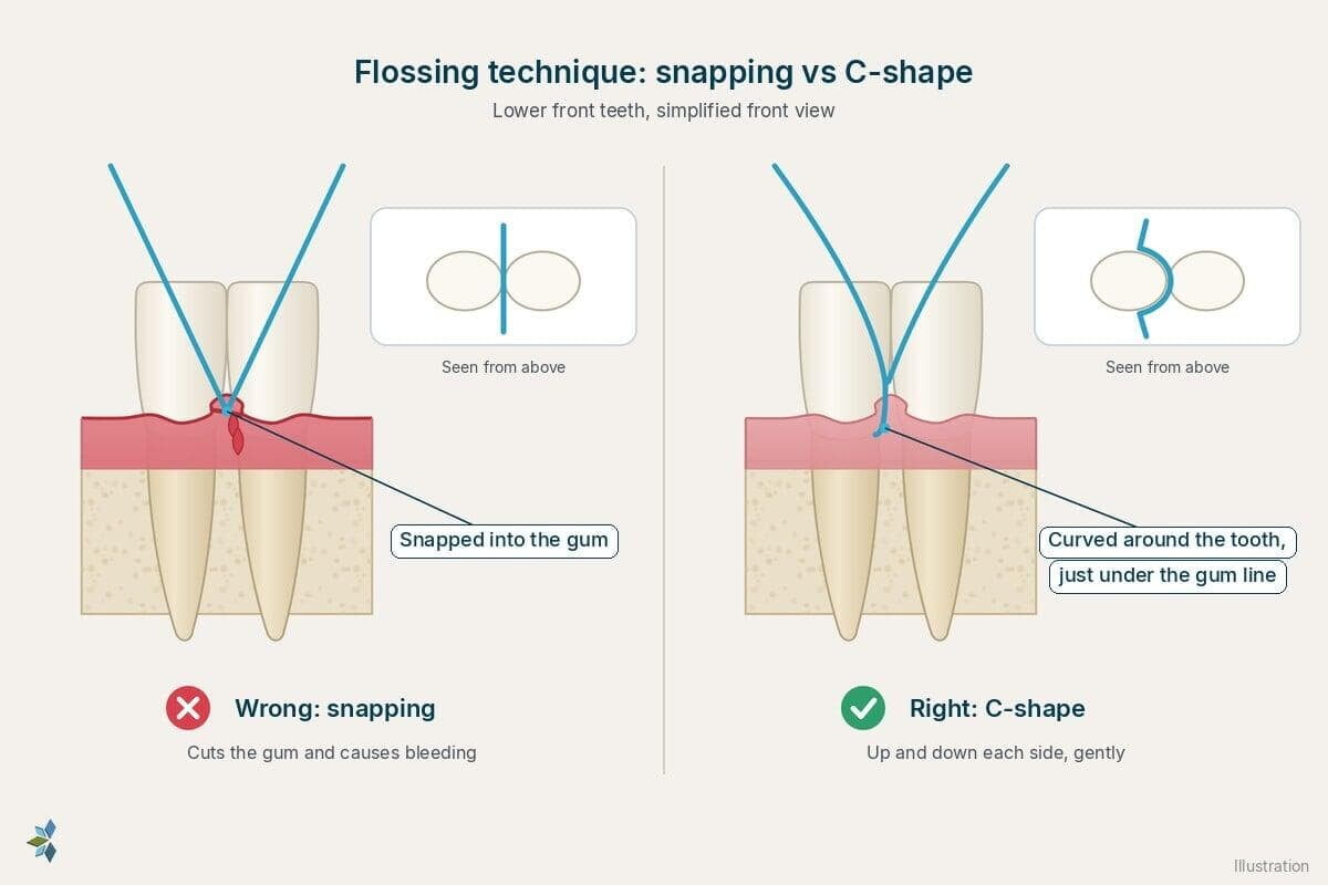 Two close-up drawings of floss between two teeth: on the left, marked wrong, the floss is snapped straight down into the gum, which is red and bleeding; on the right, marked right, the floss is curved into a C-shape around one tooth and slid gently just under the gum line
