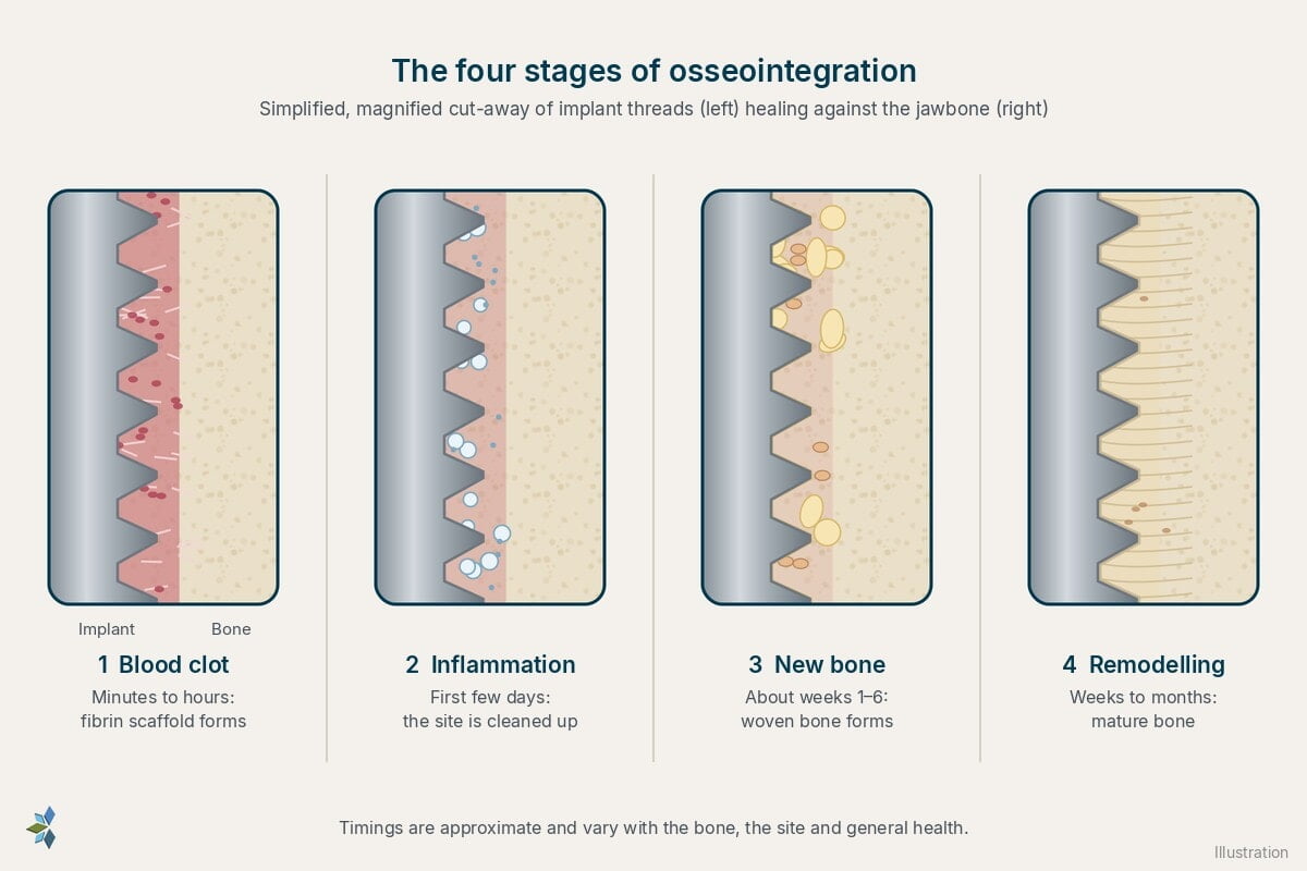 Four-panel diagram of an implant thread in bone over time: a blood clot filling the gap in the first hours, inflammatory cells clearing the site in the first days, new woven bone forming on the implant surface over the following weeks, and dense, mature bone around the thread after remodelling over months