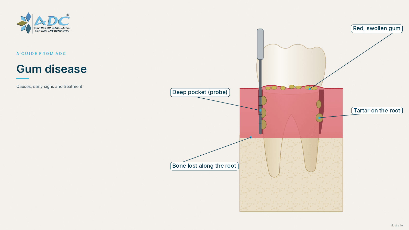 Gum disease: causes, early signs and treatment