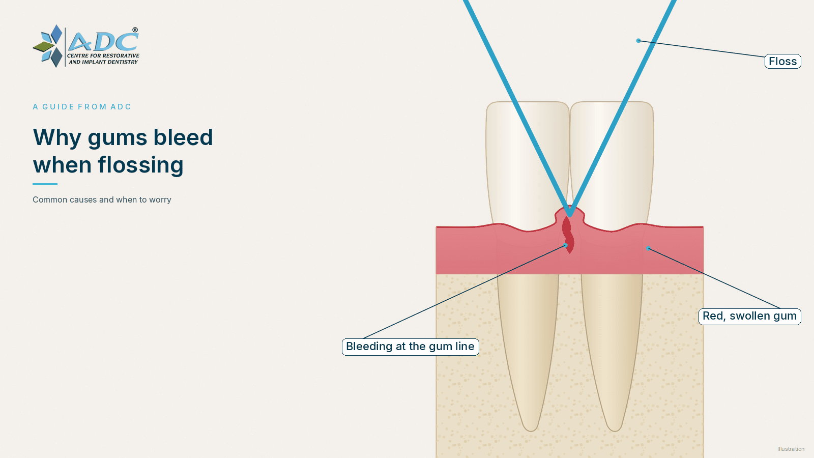 Why do gums bleed when flossing? When to worry
