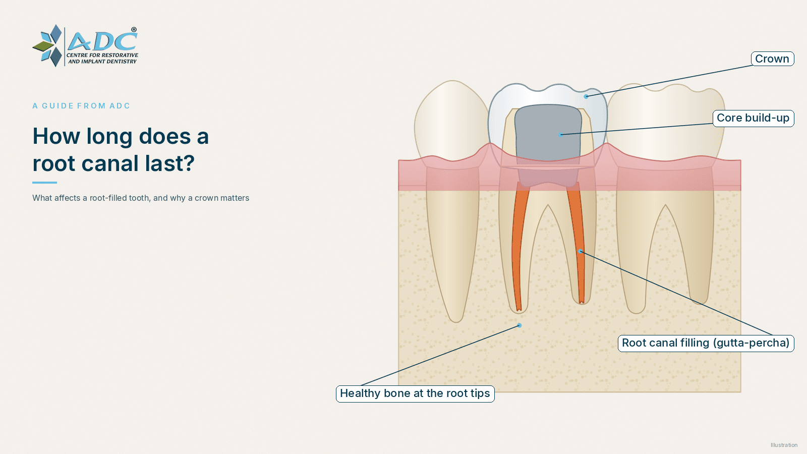 How long does a root canal last? What affects it
