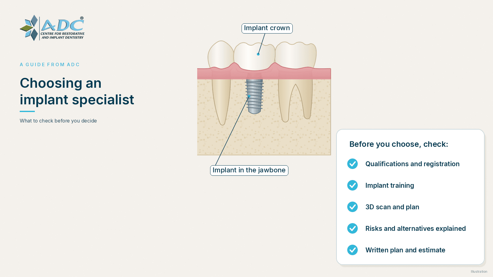 How to choose a dental implant specialist: a checklist