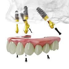 6 Stages of Dental Implant Treatment