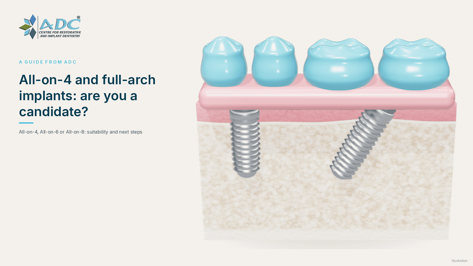 Illustration of a jaw section with no natural teeth: one upright and one tilted implant support a fixed full-arch bridge with a gum-coloured base