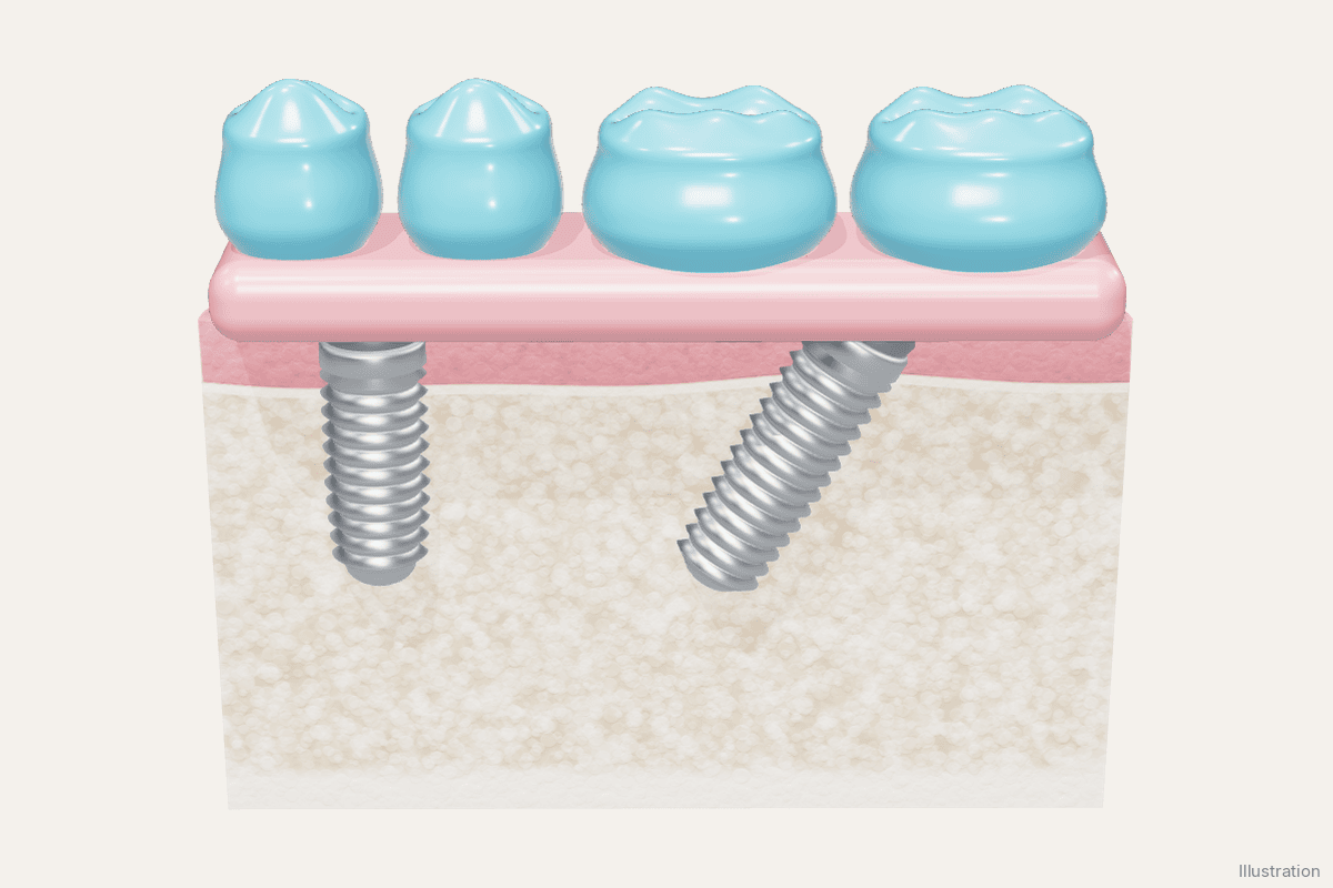 Illustration of an upright front implant and a tilted back implant supporting a fixed full-arch bridge