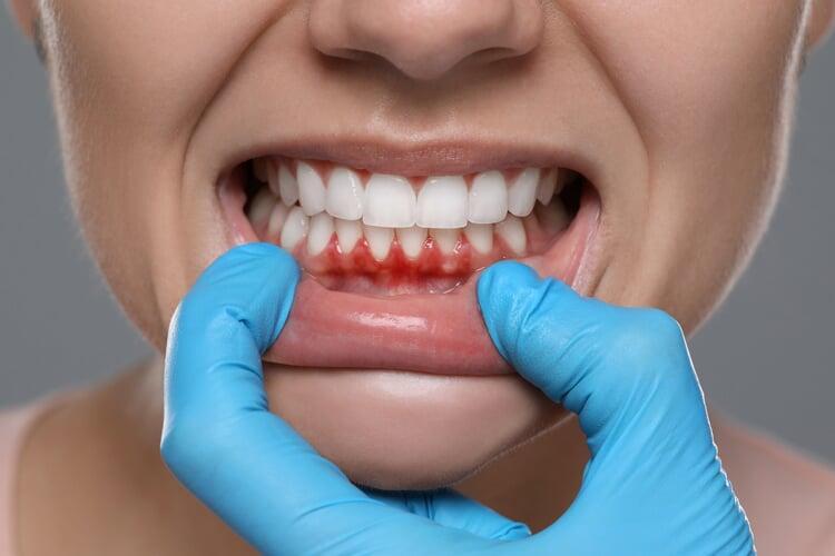 Sensitive Teeth Treatment: Restoring Comfort and Protecting Your Smile