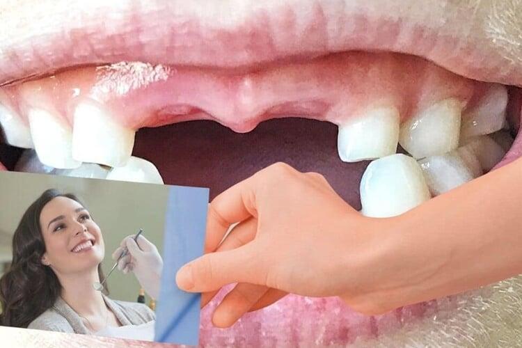 Crowns & Bridges: When Do You Need Them & How Dr. Mohit Dhawan of ADC Designs Them with CAD-CAM: