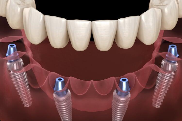 All-on-4, All-on-6 & All-on-8 Implants: Which Option Suits You Best?