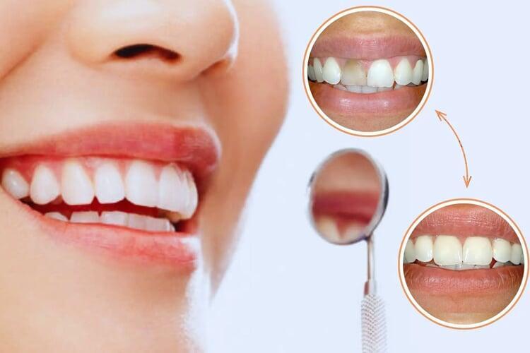 Modern Smile Makeovers: What Are Your Options?