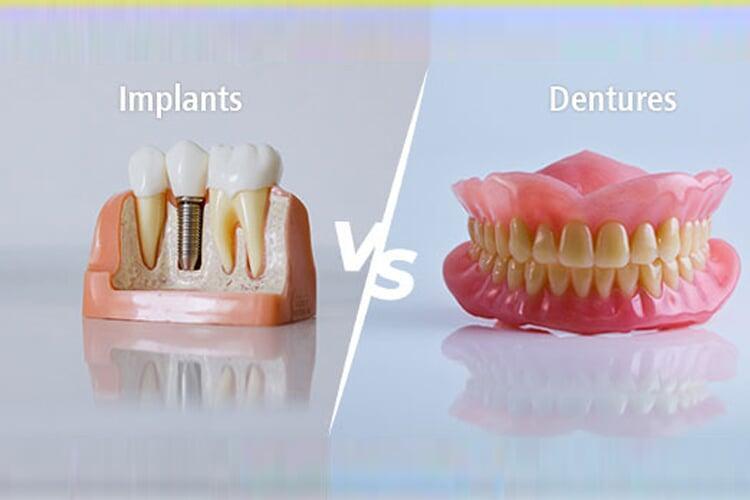 Dental Implants vs Dentures – Which Is Right for You?