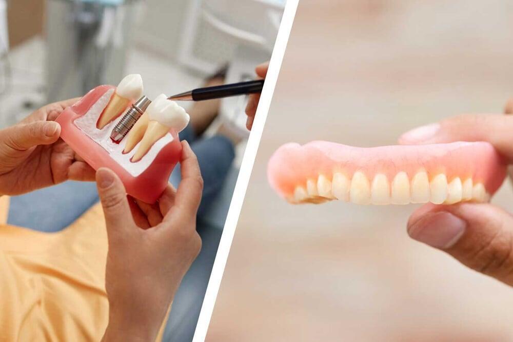 Dentures vs. Implants: How to Choose, by Dr Mohit Dhawan, leading dental surgeon of Chandigarh