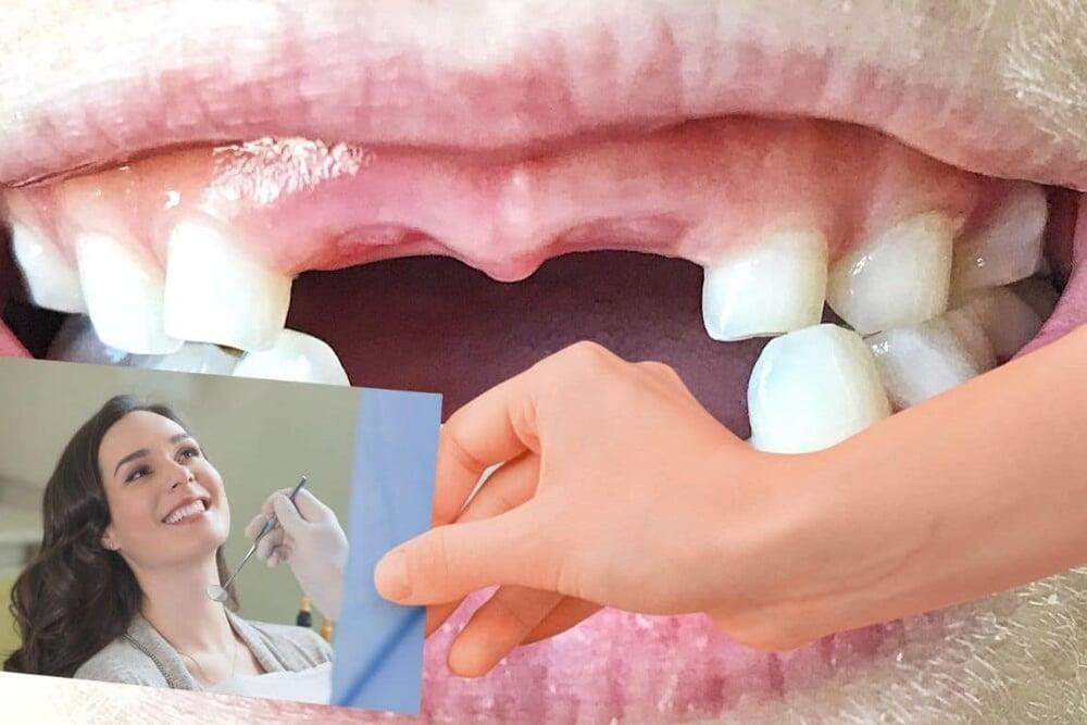 From Gaps to Grins: Transforming Smiles with Dental Bridges by Dr Mohit Dhawan, leading Implantologist of Chandigarh