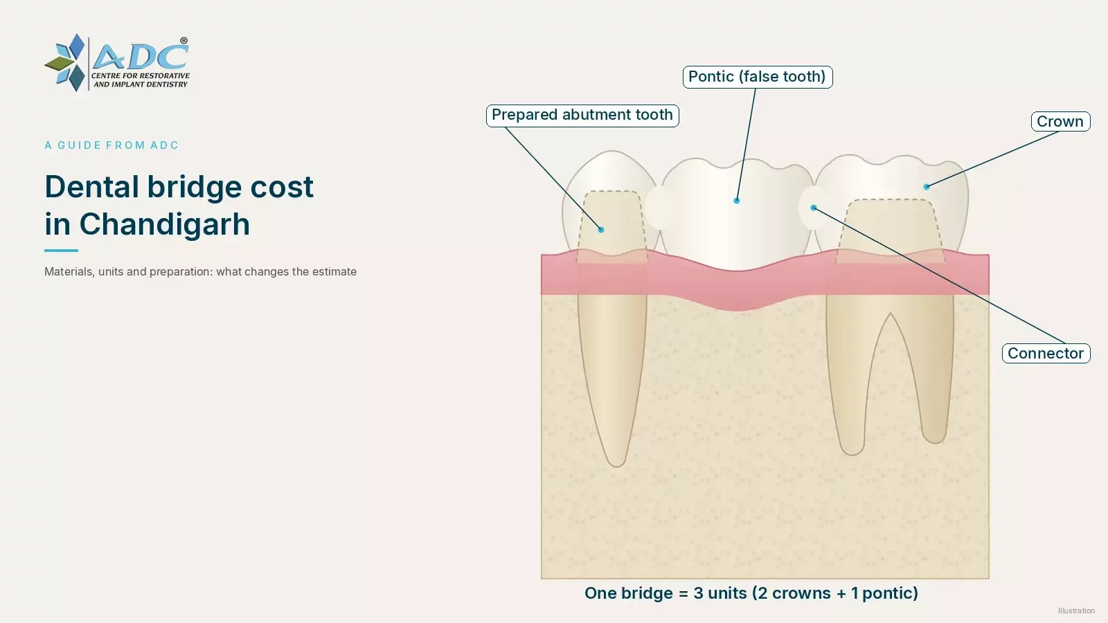 Dental bridge cost in Chandigarh: what affects it