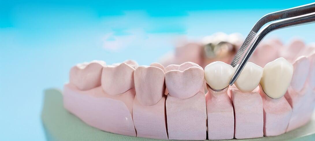 Cost of Dental Bridges in Chandigarh, by Dr Mohit Dhawan of ADC, best doctor for dental implants
